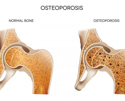 bone density testng 700x460 495x400